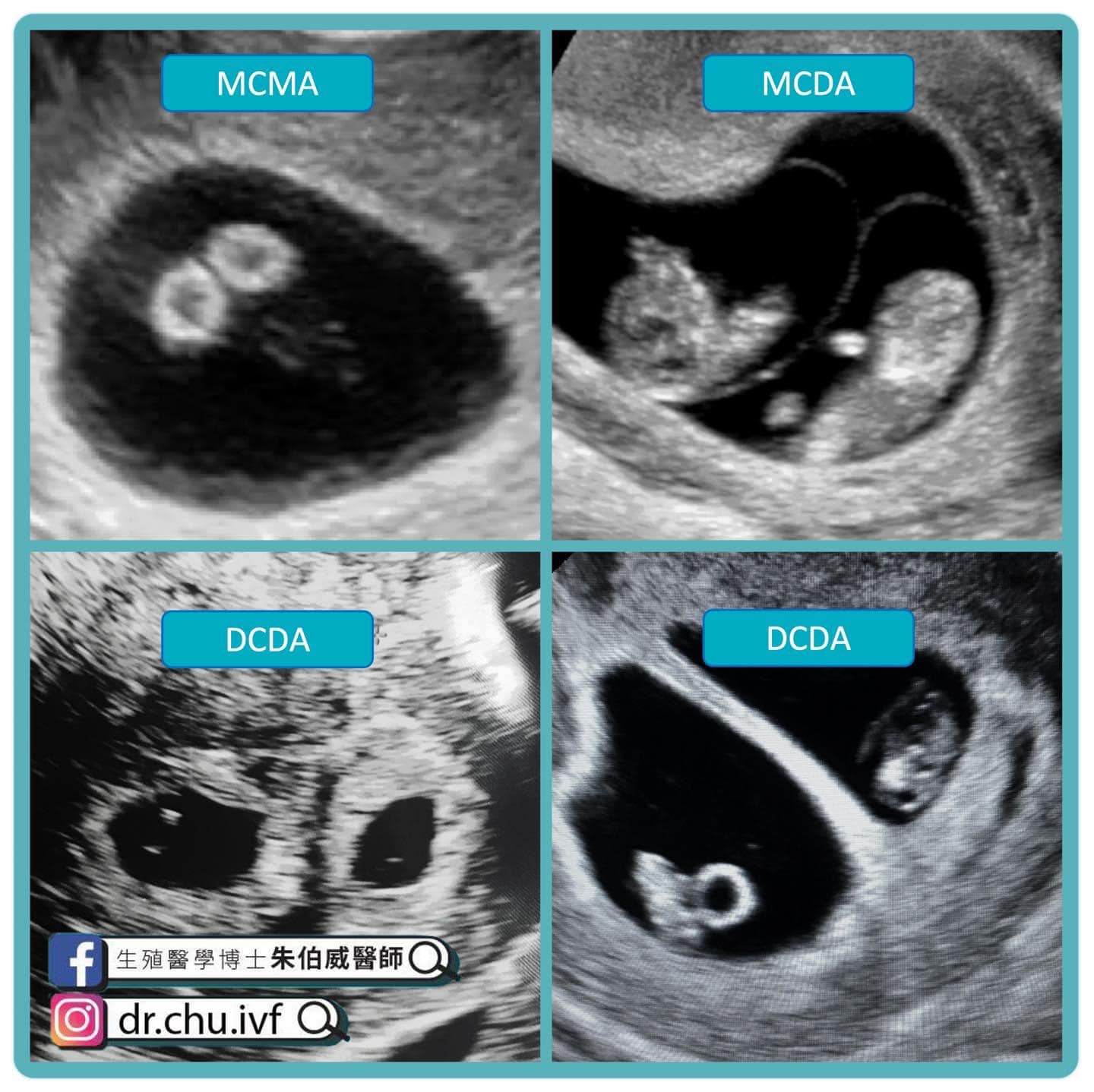 我的雙胞胎寶寶是同卵還是異卵– 蘇怡寧醫師愛碎念